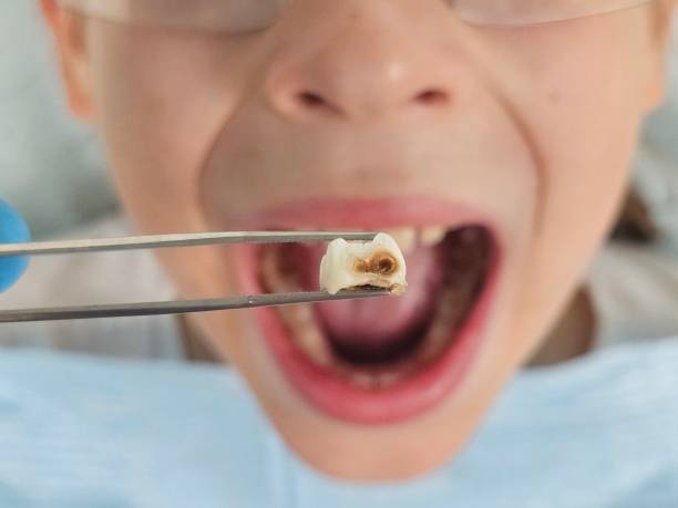 Best Pediatric Emergency Dentist in Glenwood, IL